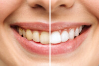 teeth whitening tips home remedies