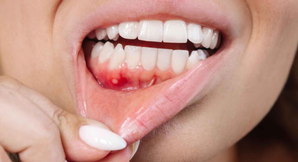 Close-up of gums irritated after teeth whitening treatment, showing mild gum burn and safe dental care context.
